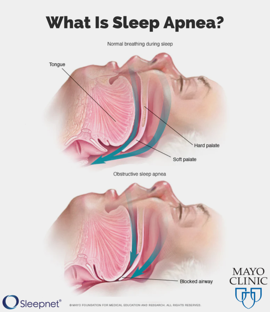 What Is Obstructive Sleep Apnea Sleepnet Corporation 3990
